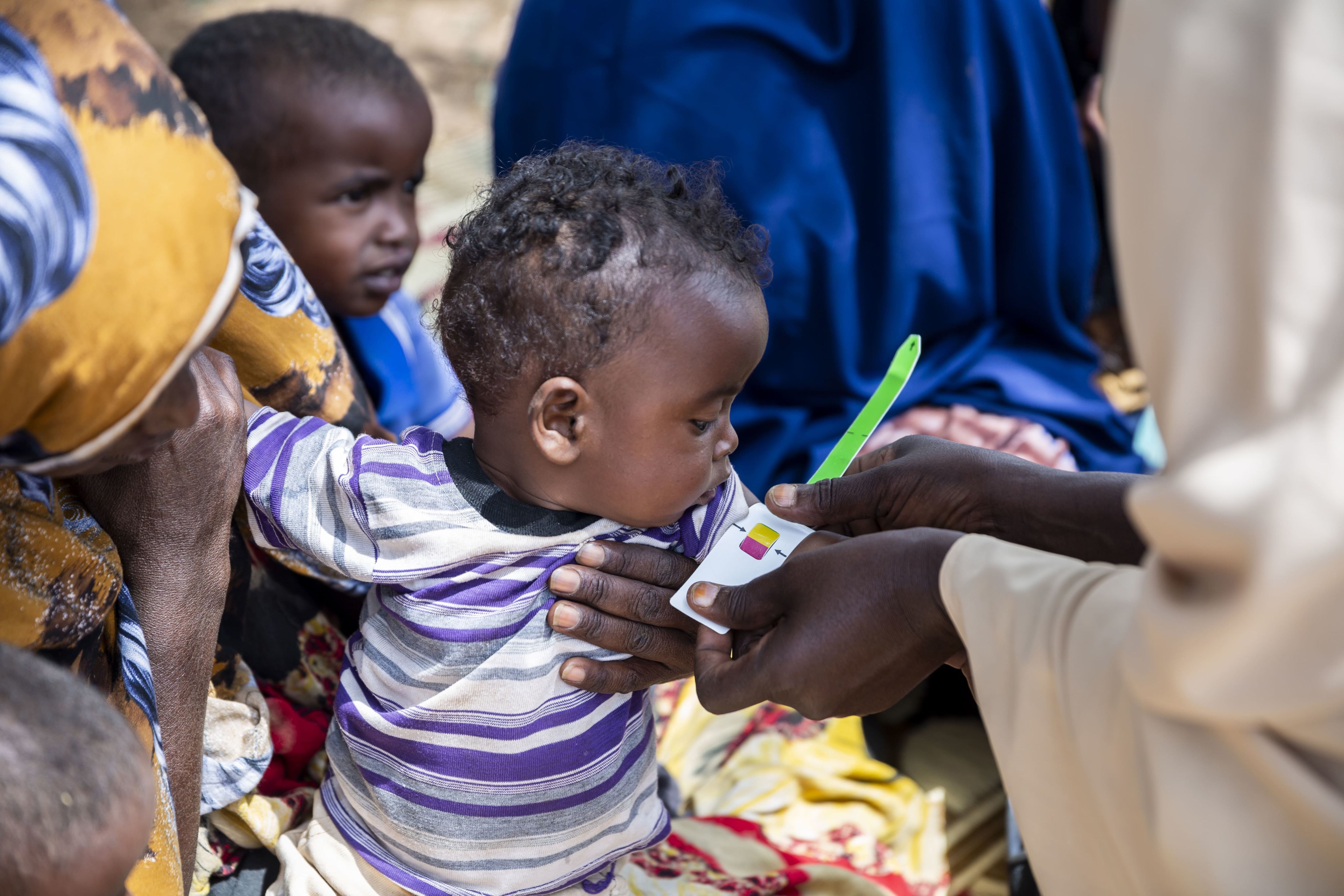 Somalia, medico misura il braccio di un bambino con un braccialetto MUAC per valutare il suo stato di salute